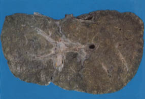 A Liver infected by hepatitic C